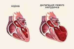 Дилатация левого желудочка что это. Дилатация левого желудочка. Дилатация желудочков сердца. Дилатация миокарда левого предсердия. Расширение полостей сердца дилатация.