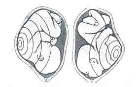 Ребенок расположен справа. Выслушивание сердечных тонов плода. Аускультация многоплодной беременности. Аускультация сердца плода. Аускультация сердечной деятельности плода.