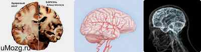 Болезни мозга названия. Ишемия головного мозга снимок. Ишемия головного мозга 3-я стадия.